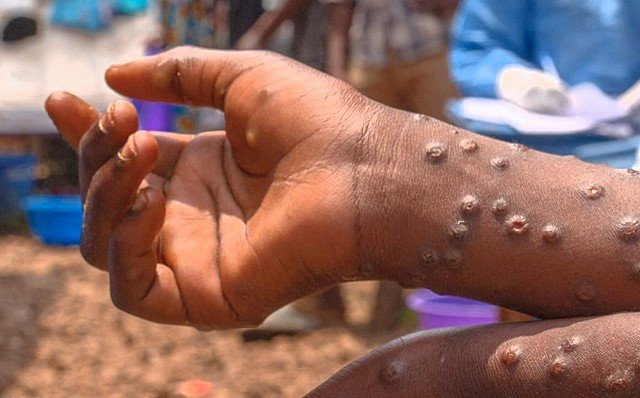 Africa’s Mpox crisis intensifies as WHO renews global public health emergency